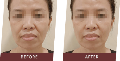 Before & After Instalift EMS