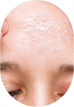 Dry and flaky skin in need of hydration.