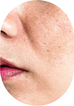 Fine lines and loss of elasticity.