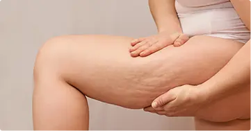 Cellulite Reduction