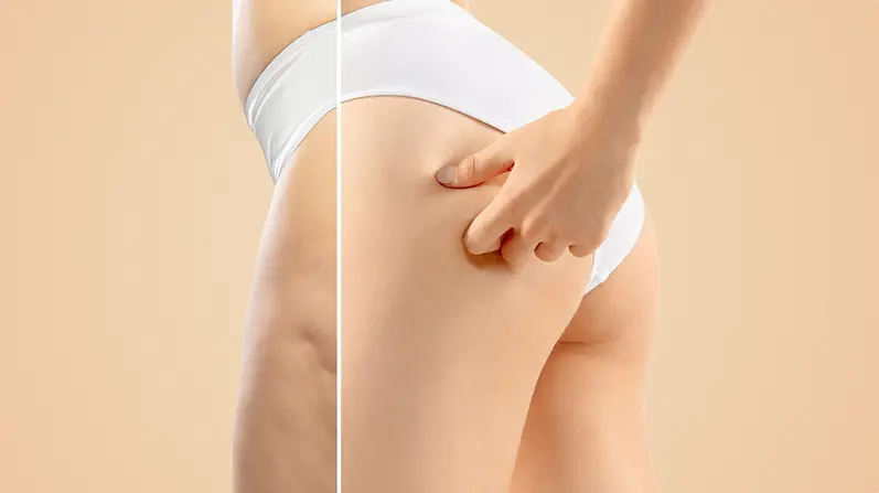 Cellulite Reduction