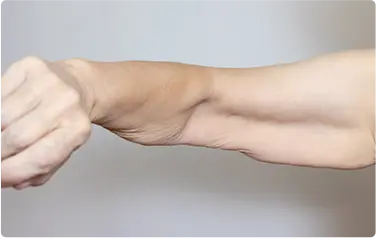 Loose Skin After Weight Loss