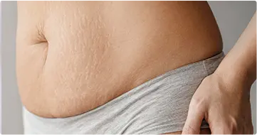 Post Pregnancy Skin Recovery