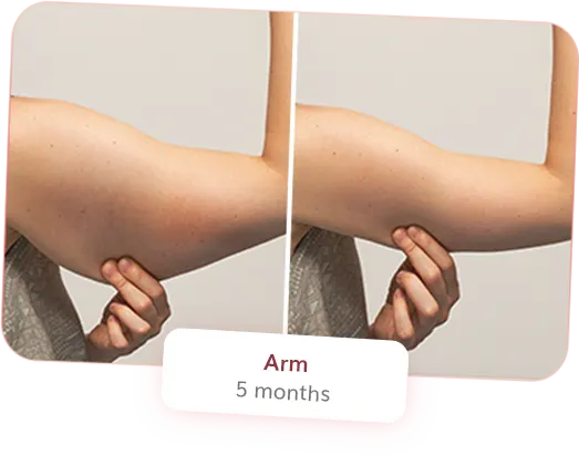 Arms