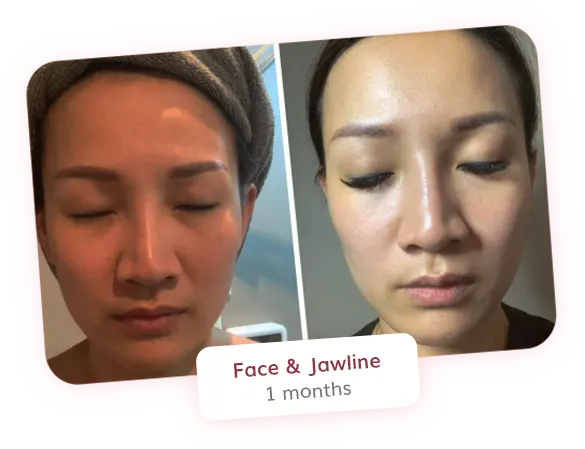 Face and Jawline - 1 month