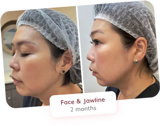 Face and Jawline - 2 months