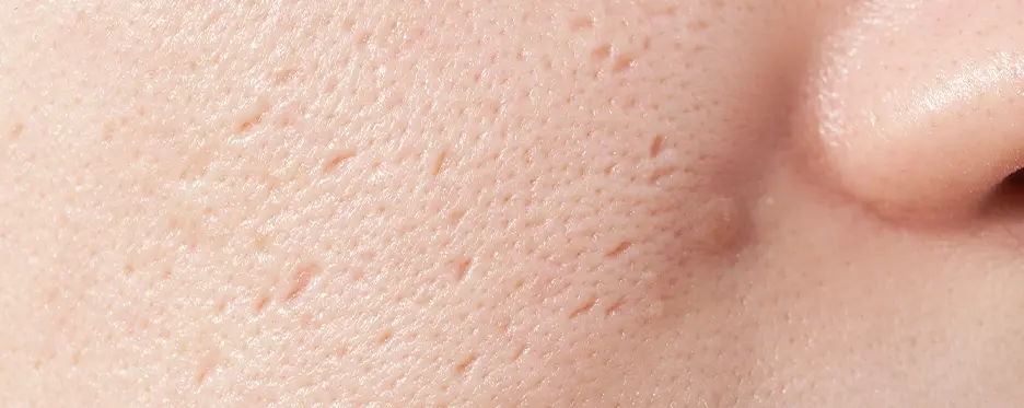 Clogged Pores