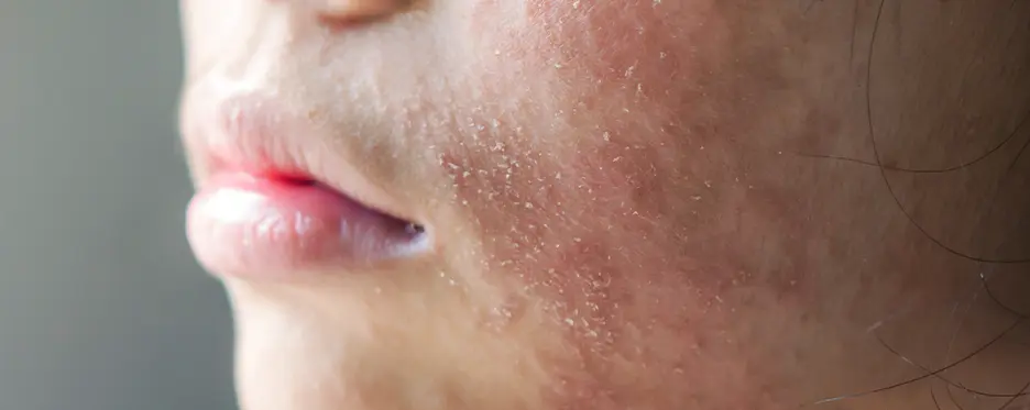 Dryness