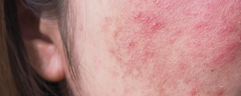 Sensitive Skin